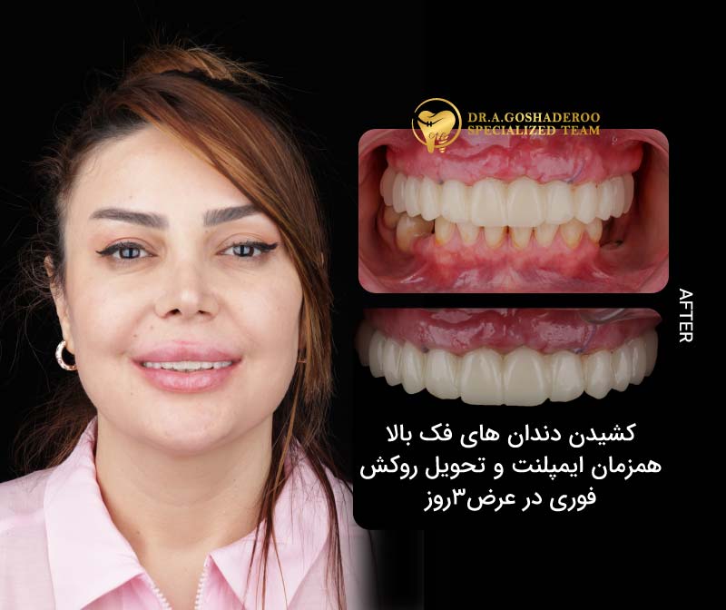 ایمپلنت
